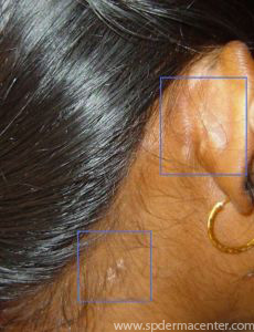 Vitiligo-treated